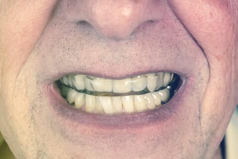 Mand med gennemsigtig bidskinne i munden - individuelt tilpasset beskyttelse mod tandskæren og slidte tænder