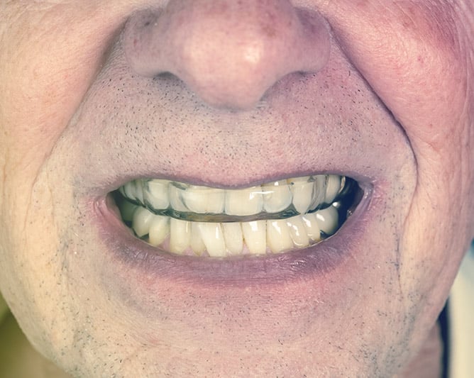 Mand med gennemsigtig bidskinne i munden - individuelt tilpasset beskyttelse mod tandskæren og slidte tænder