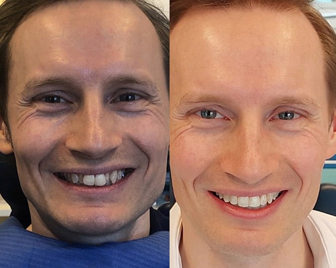 Glad patient har fået lavet tandretning med Invisalign. Usynlig tandretning.