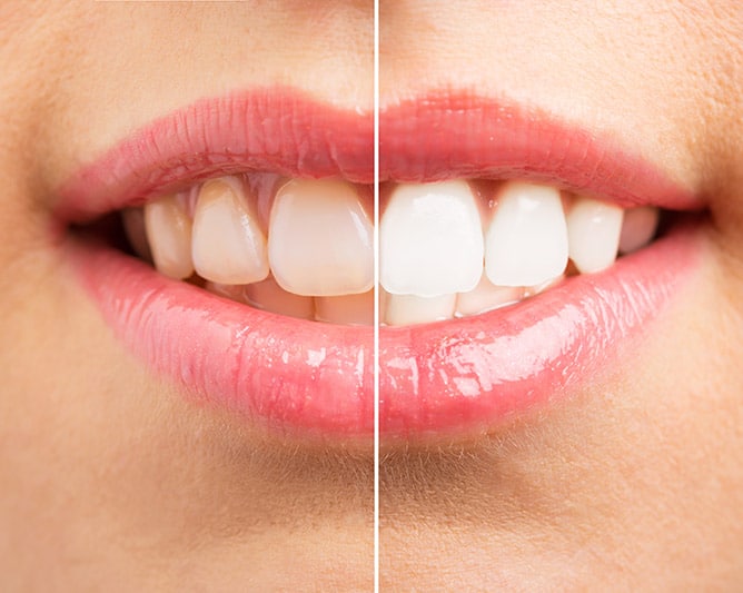 Tandblegning på Vesterbro – før og efter billede der viser forskellen mellem naturlige tænder og et hvidere smil efter professionel behandling.
