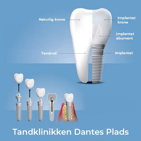 Illustration af tandimplantat med tandkrone, tandrod og implantatdele – professionel tandbehandling hos Tandklinikken Dantes Plads i København.