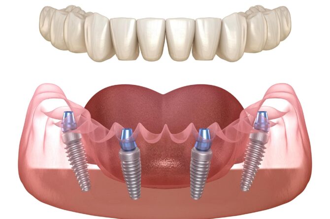 Illustration af helprotese på fire implantater hos Tandklinikken Dantes Plads