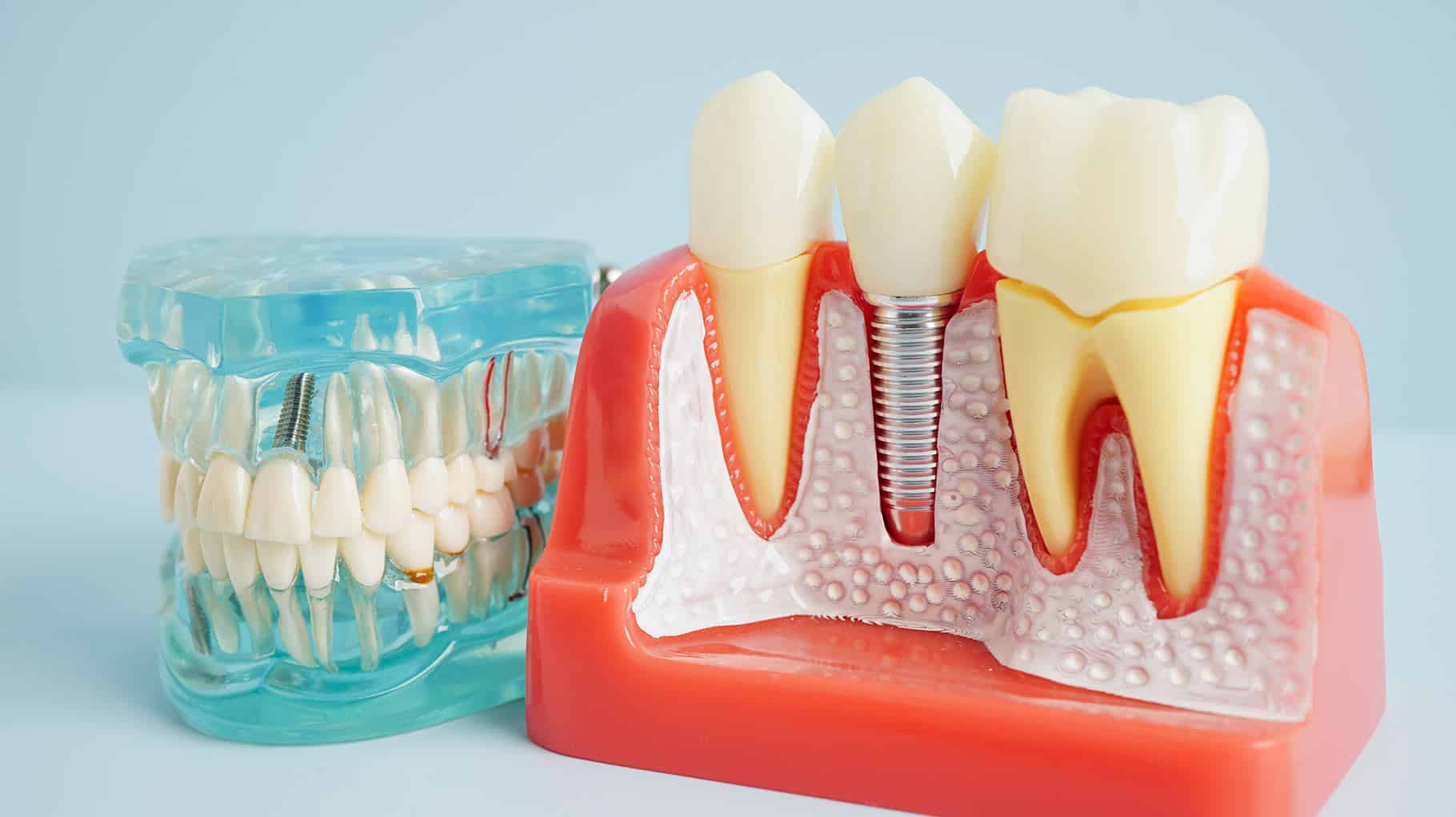 Model af implantat tænder Vesterbro – moderne tandimplantater der erstatter manglende tænder med stærke og naturlige løsninger.