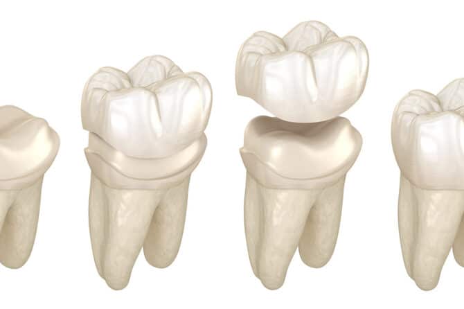 En illustration af en tandkrone fra slibning af tand til den færdige tandkrone.